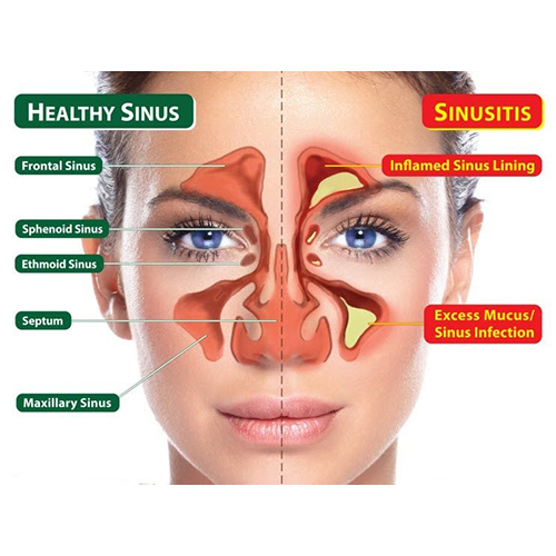 Sinusitis Treatment